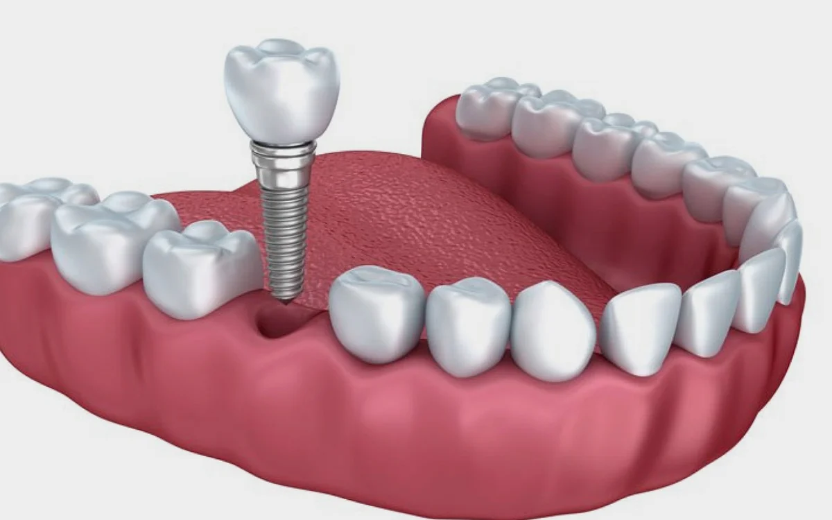 Root Canal Treatment (RCT)