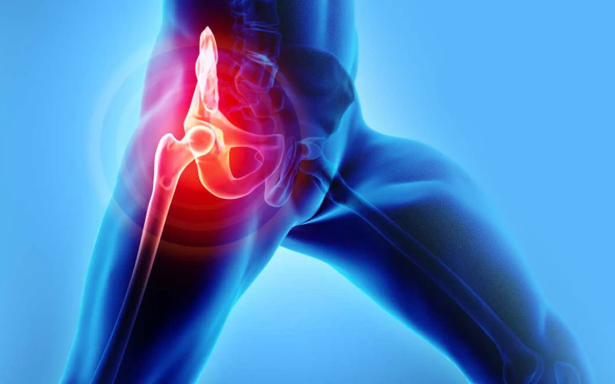 Total Hip Replacement