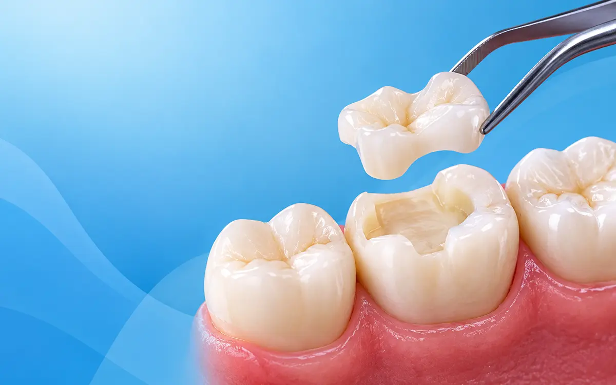 Dental Onlays