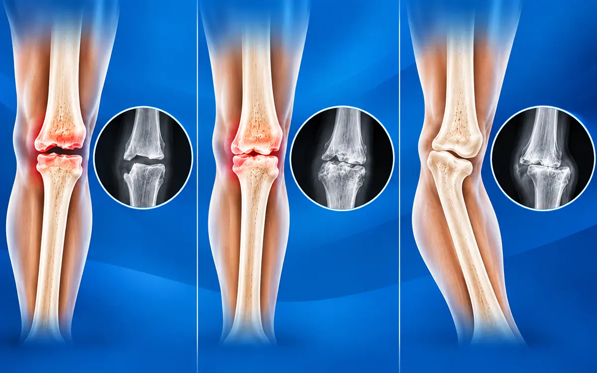 Non-union, Delayed Union & Malunion Surgery